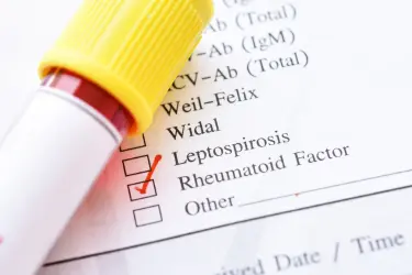 A vial of blood tested for Rheumatoid Arthritis